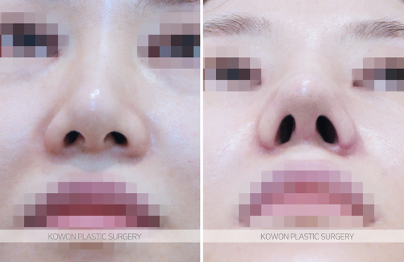 Looking at the Change Process Before and After Bulbous Nose Surgery and the Flow of Nasal Tip Structural Improvement image 7