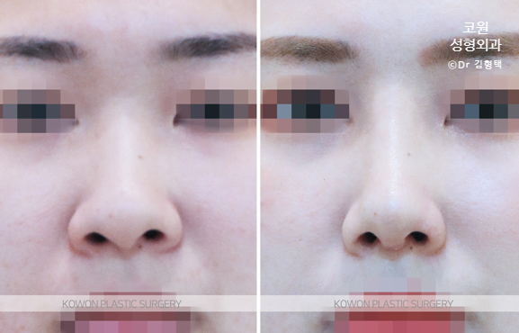 코끝 연골묶기 전후 단순히 모으는 변화보다 중요한 구조적 균형 관련 이미지 4