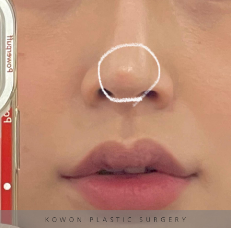 과도하게 화려한코, 귀연골에 비중격코수술로 자연스럽게 개선 됐어요! 관련 이미지 7