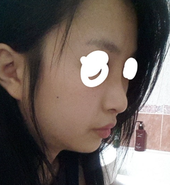 Q. After surgery for an upturned nose, it became a hooked nose. What is the solution? image 6