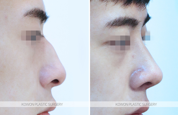 How Much Does a Man’s Hump Nose Surgery Change Your Appearance? Before-and-After Changes and Recovery Time Summary image 6