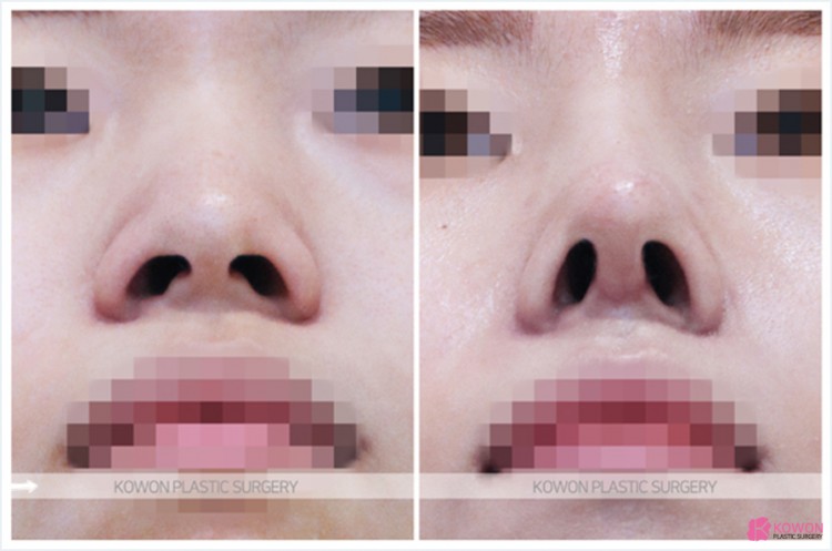 Q. 코수술 후 코안 점막 부음(코수술부작용)일까요? 관련 이미지 7