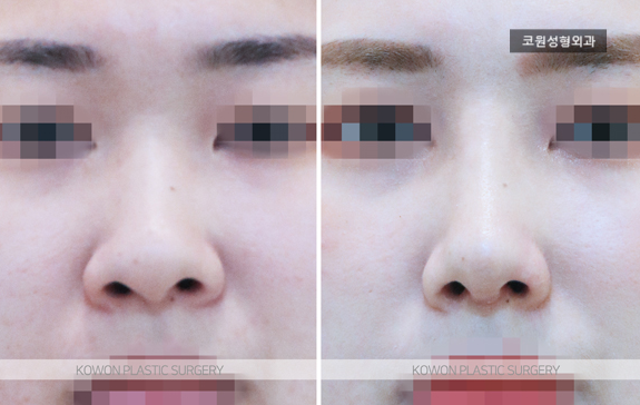 코끝연골재배치로 얼굴 중심 입체감을 살린 자려한 코라인 사례 관련 이미지 4