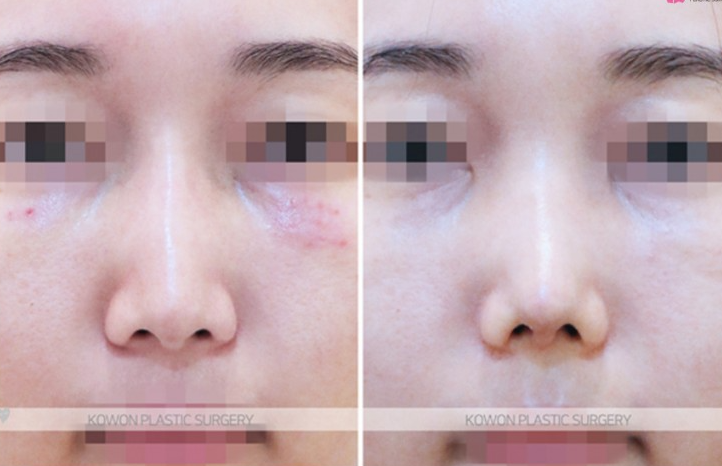 Q. Considering Surgery for the Bridge Between the Eyebrows and the Nose: Side Effects of Nasal Bridge Surgery and Key Points for Revision Surgery image 10