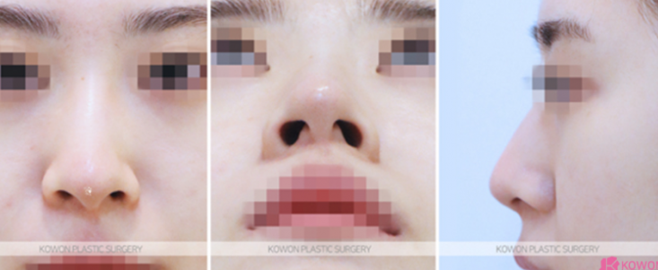 Q. Worried About Crooked Nose Surgery, What Nose Surgery Direction Should Be Considered Before Double Jaw Surgery image 3