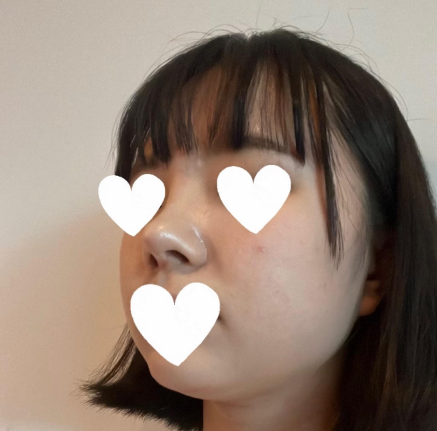 I Was Reborn with Small, Bulbous Nose Correction and Functional Nose Surgery for Deviated Septum at Kowon Plastic Surgery image 9