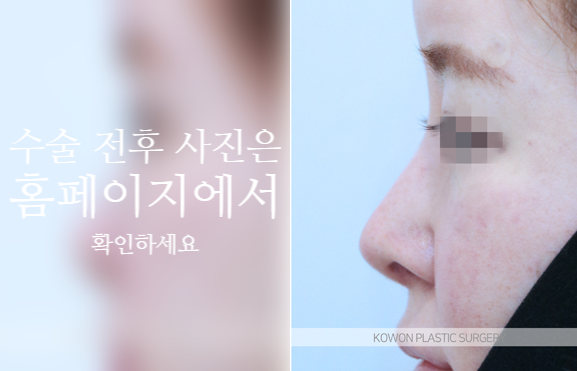 자가늑 코성형으로 코끝 처짐과 구조를 함께 고려해야 하는 이유 관련 이미지 8