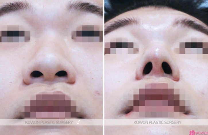 Q. Cartilage Pain After Nose Surgery: Is It a Side Effect of Male Rhinoplasty? Causes and How to Handle It image 7
