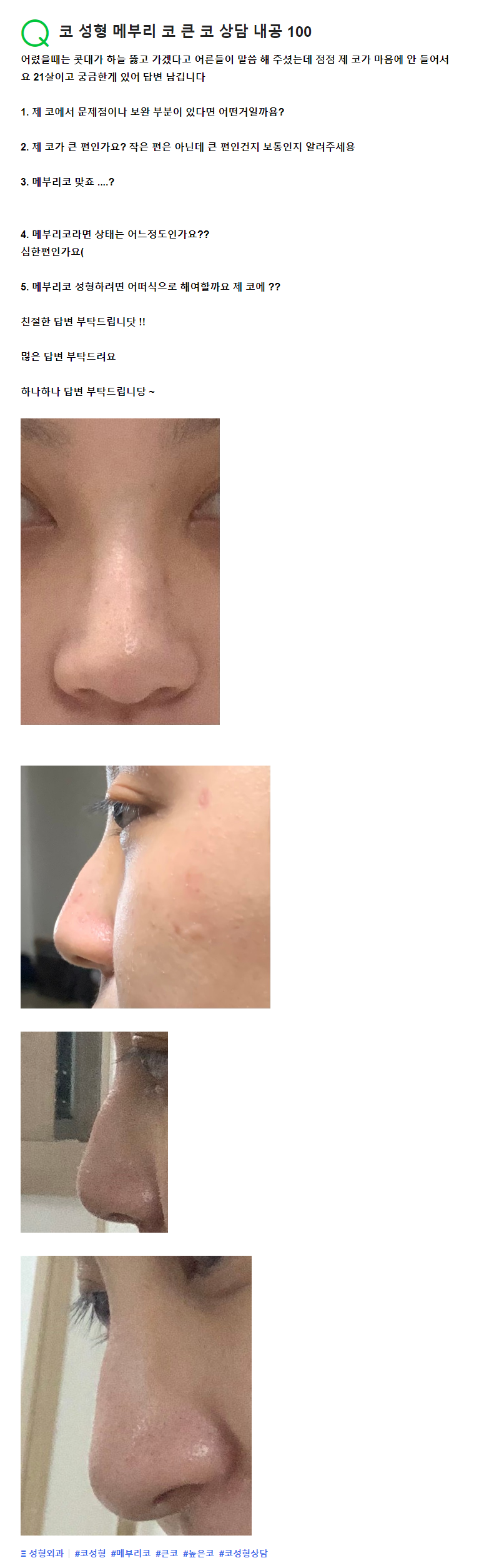 Q. I’m worried about my aquiline nose—please advise on surgery for a large nose. image 2