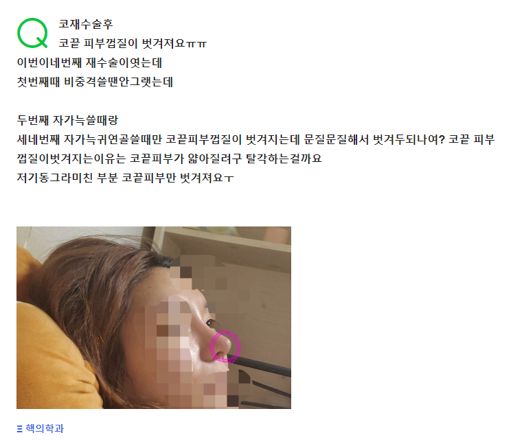 Q. I used an autologous rib graft for revision rhinoplasty, and the skin is peeling offㅠㅠ image 2