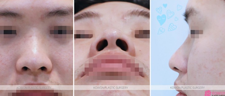 Q. Can a large nose be improved with nasal bridge osteotomy and tip surgery? (Question about male rhinoplasty before and after) image 3