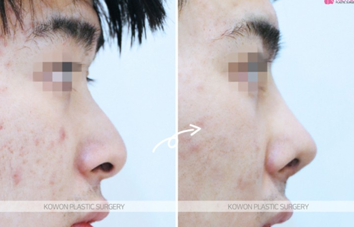 Q. Is it just a simple issue after male rhinoplasty in Gangnam? Resolving concerns about revisional surgery for nasal inflammation image 10
