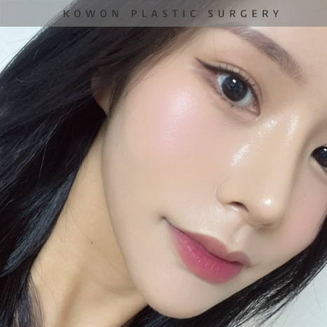 과도하게 화려한코, 귀연골에 비중격코수술로 자연스럽게 개선 됐어요! 관련 이미지 29