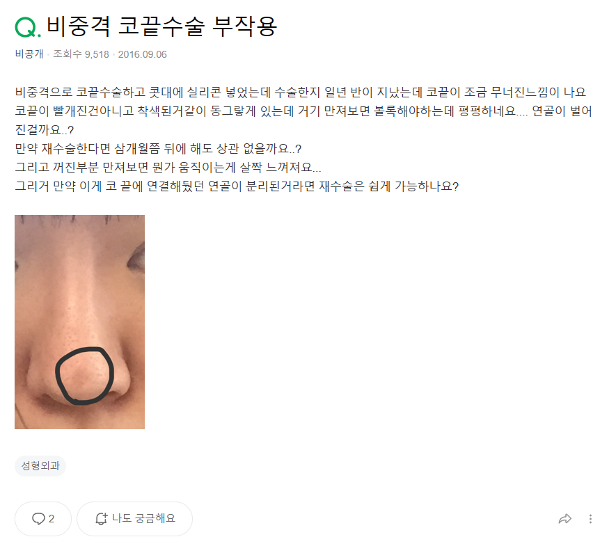 Q. Is Kangnam nose revision surgery necessary for a nose tip surgery complication? image 2