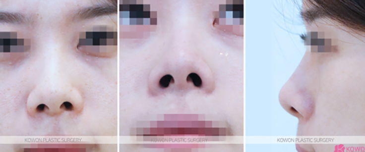 Q. Questions About Bulbous Nose Surgery and Post-Jaw Surgery Nose Surgery Answered image 3