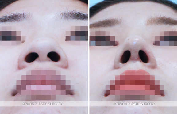코끝연골재배치 어떤 변화가 나타날까요? 복코 라인 개선 과정 정리 관련 이미지 6