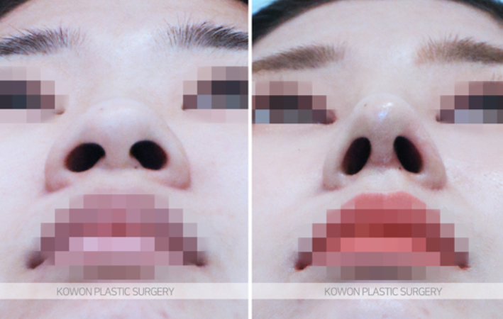 Q. Are there differences in nostril shape depending on the type of nose surgery and incision method, or not? image 5
