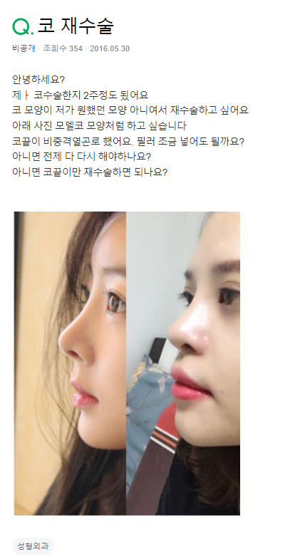 Q. I had surgery with septal cartilage, but I want a revision rhinoplasty.. image 2
