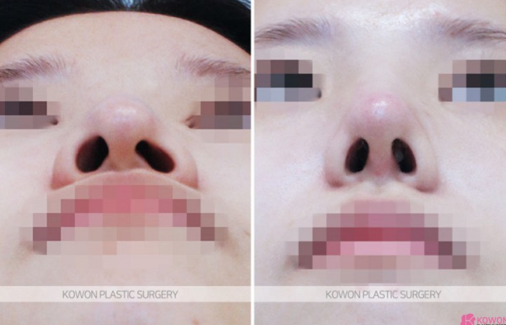 Q. Is drinking and smoking okay one month after nose surgery? A summary of nose-tip pulling symptoms and 기준 image 8
