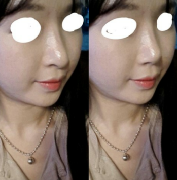 Q. After surgery on the nasal tip and bridge, I think my nose has become an arrow nose image 4