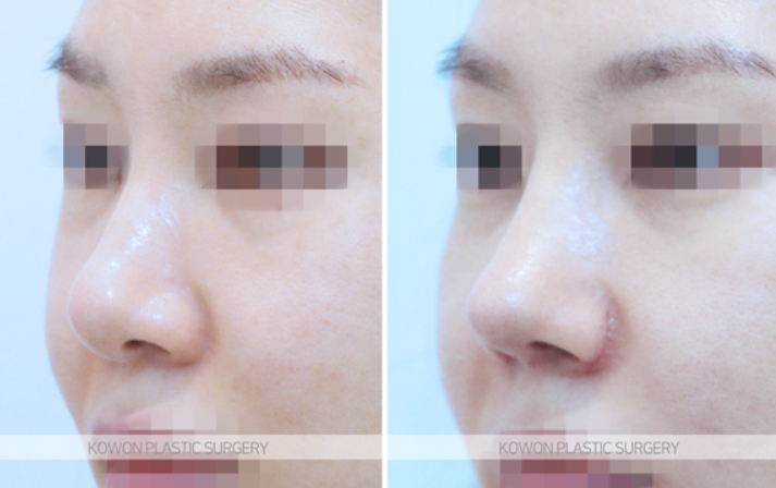 Q. 고민 about alar base surgery: do the nostrils need shape correction? image 5