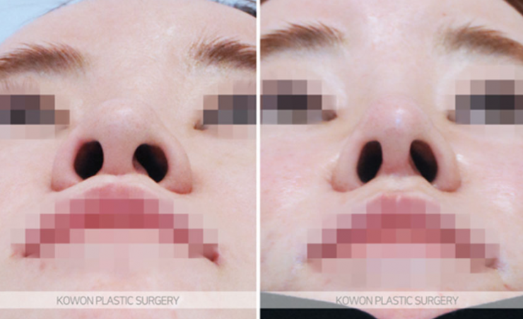 Q. Concerned about revision surgery for a long and wide nose: What is the key to natural-looking nose surgery results? image 5