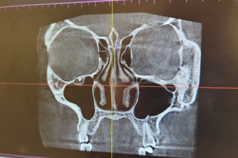 This is a review of nose surgery for a bulbous nose using donated rib cartilage at Kowon Plastic Surgery! image 10