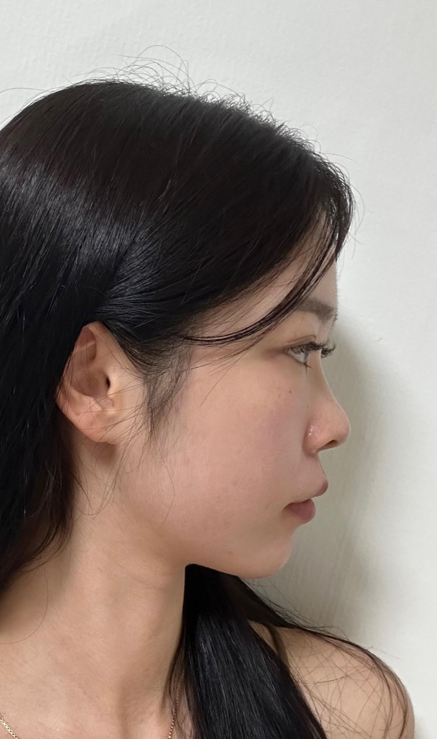 I successfully got the nose shape I wanted with 비순각 surgery and low-nose rhinoplasty! image 2
