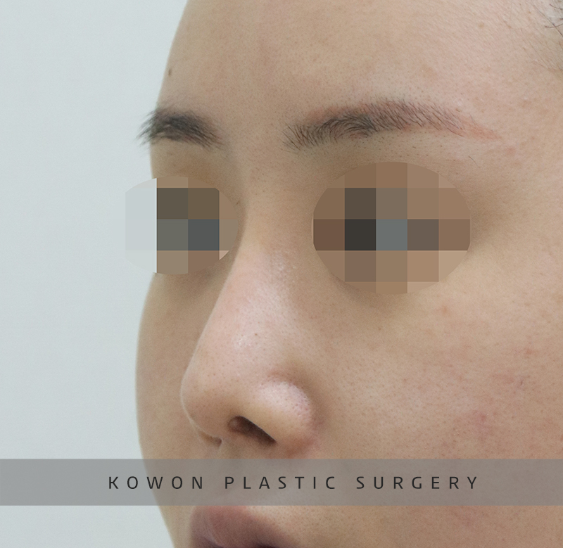Revision Rhinoplasty Using Autologous Rib Cartilage, I Resolved My Concerns Through Surgery! image 7