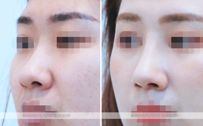 Q. Are there differences in nostril shape depending on the type of nose surgery and incision method, or not? image 4