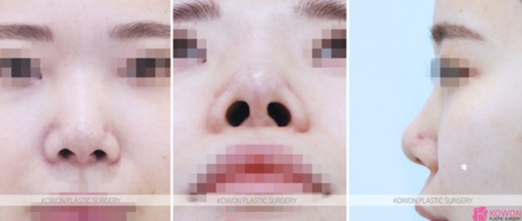 Q. I’m 고민 whether this is a side effect of cartilage nose surgery after revision rhinoplasty near Sinsa Station image 6