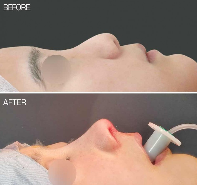Q. When having bulbous nose surgery and nostril reduction, is cutting the alar rim enough? image 5