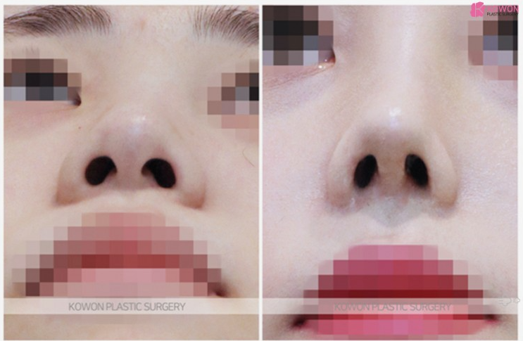 미간부터 코끝까지 매끄럽게! 입체감을 살리는 코원성형외과의낮은코수술 노하우 관련 이미지 4