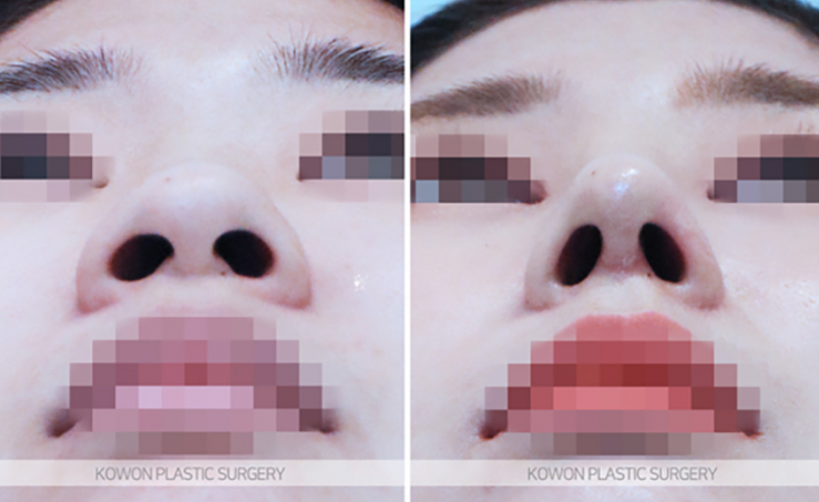 Q. I’m worried because of the difference before and after nostril reduction surgery image 8