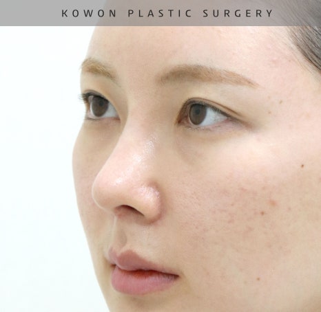 코원성형외과 코재수술성형외과에서 자가늑코재수술로 원하는 코를 주셨어요! 관련 이미지 11