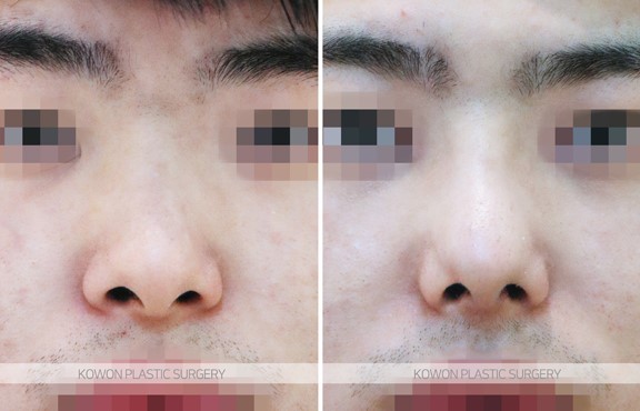 Q. In a deviated nose surgery, will failing to correct the crooked nasal bone cause problems with nose growth? image 4