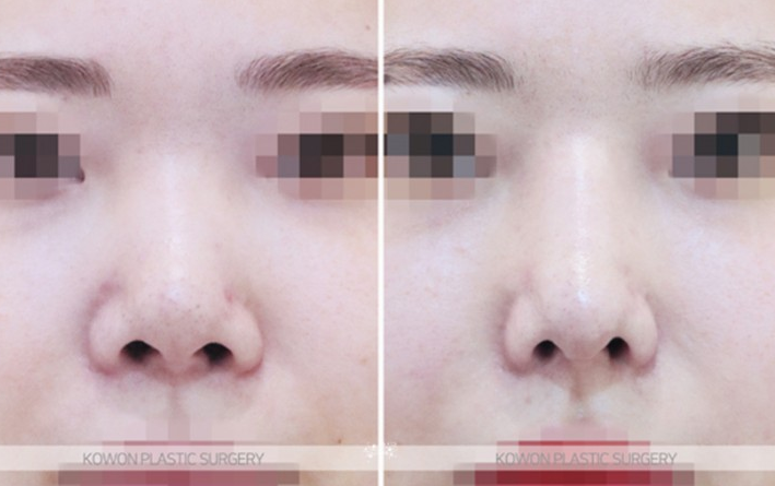 Q. If You’re Considering Revision Rhinoplasty image 7