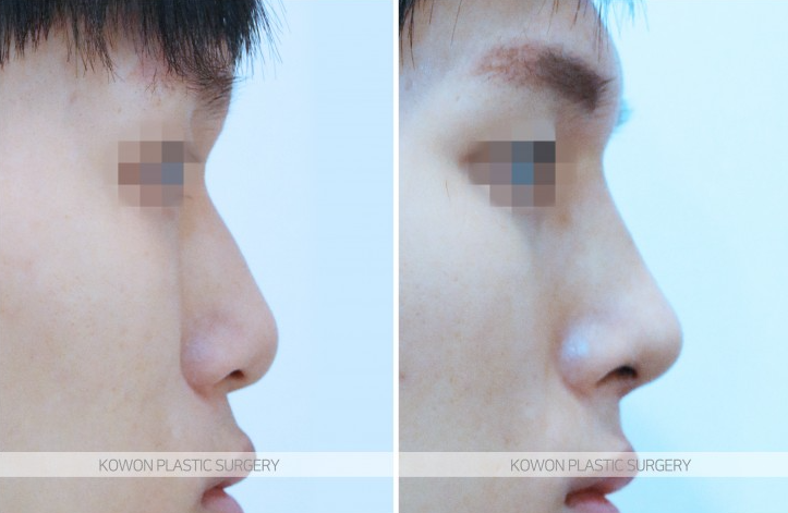 Q. It seems like swelling from low-nose surgery—would it be better to remove the silicone? image 4