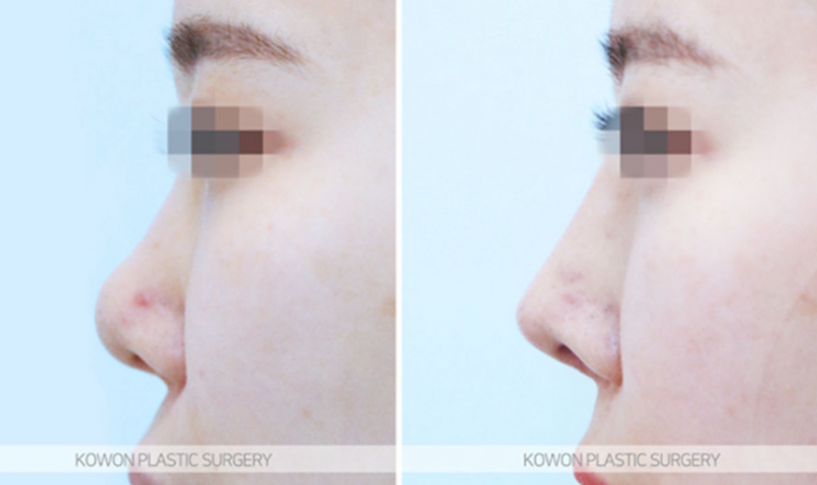 Q. Is a change in nose surgery silicone a case that requires revision surgery? image 9