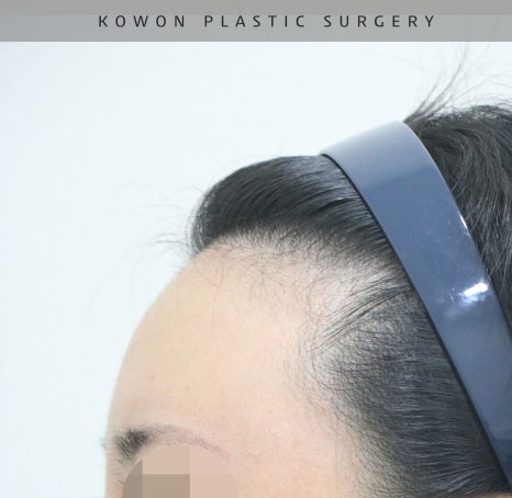 This is a review of nose surgery for a bulbous nose using donated rib cartilage at Kowon Plastic Surgery! image 20