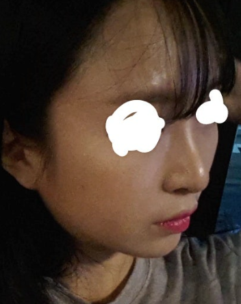 Q. After surgery for an upturned nose, it became a hooked nose. What is the solution? image 4