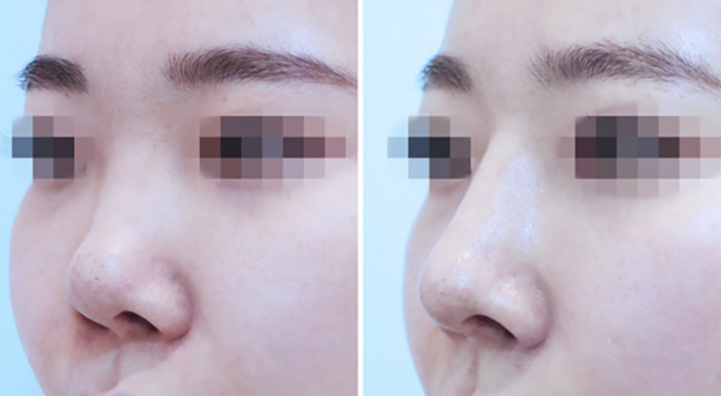 Q. Why Do the Nostrils Look Uneven After Revision Nose Surgery with Ear Cartilage? image 8