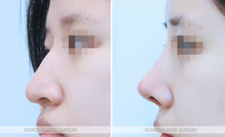 Q. I’m worried about side effects from nose surgery. Please tell me how to reduce swelling after nose surgery. image 8
