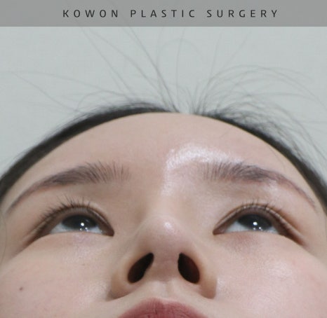 과도하게 화려한코, 귀연골에 비중격코수술로 자연스럽게 개선 됐어요! 관련 이미지 17