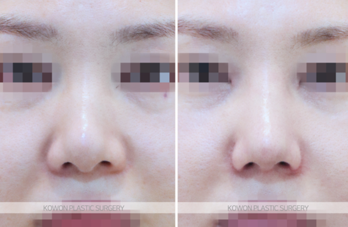 Q. 고민 about alar base surgery: do the nostrils need shape correction? image 7