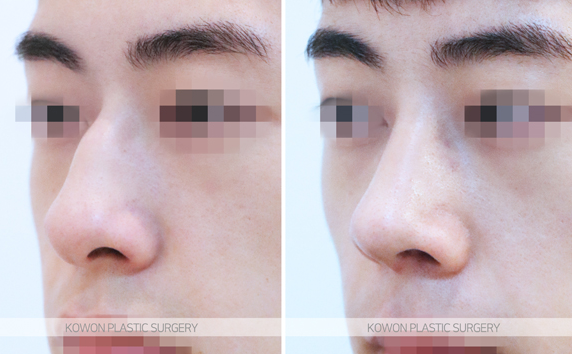 How Much Does a Man’s Hump Nose Surgery Change Your Appearance? Before-and-After Changes and Recovery Time Summary image 5