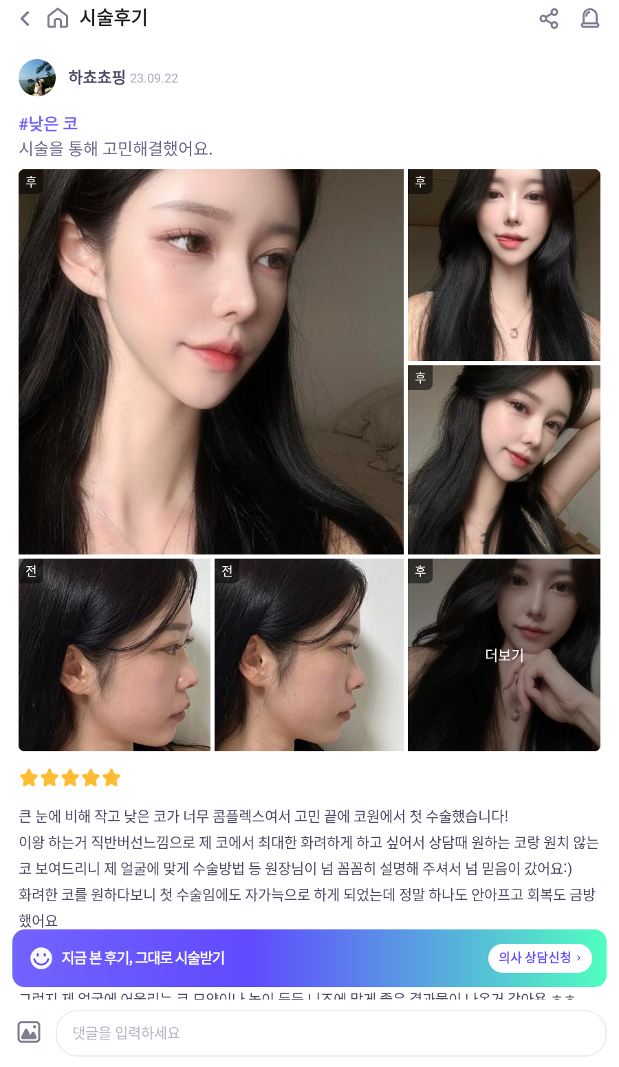 I successfully got the nose shape I wanted with 비순각 surgery and low-nose rhinoplasty! image 10