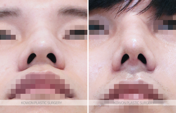 What Are the Criteria for Choosing a Good Place for Men’s Rhinoplasty? A Summary of Changes Before and After a Hump Nose Correction image 6