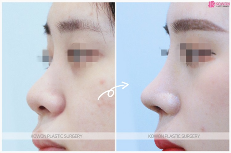 미간부터 코끝까지 매끄럽게! 입체감을 살리는 코원성형외과의낮은코수술 노하우 관련 이미지 3