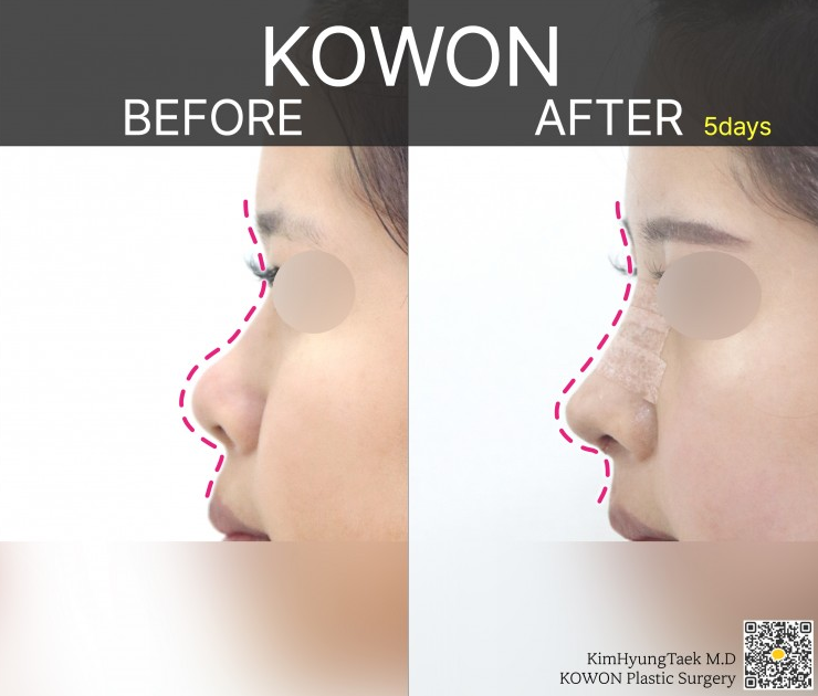 [Cowon Plastic Surgery] Refining a spread, bulbous nasal tip and flat nasal bridge at once! A natural-yet-glamorous line completed with bulbous nasal tip surgery image 3